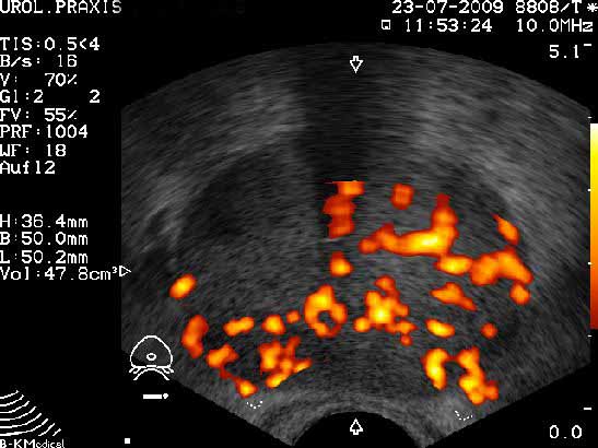 Duplexsonographie Prostata