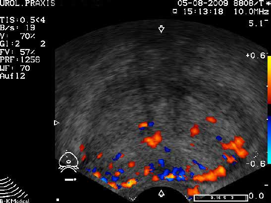 farbkodierte Prostatasonographie