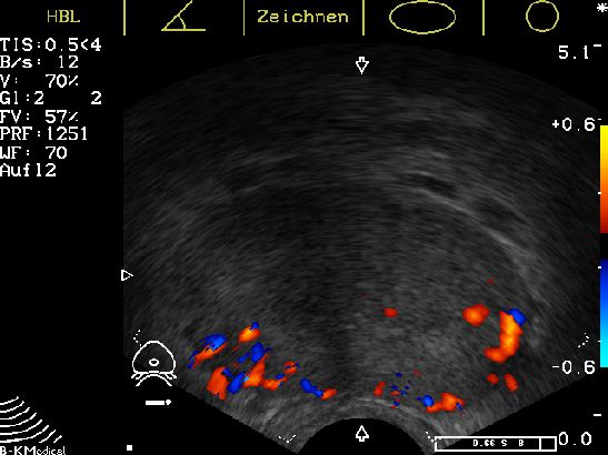 Prostata-Duplexsonographie