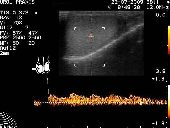 Triplexsonographie des Hodens