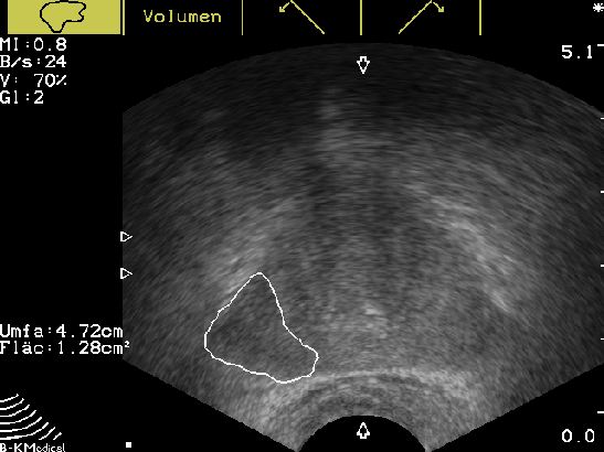 Tumorsuspekter Prostatabezirk re in der transrektalen Prostatasonographie (TRUS des Hodens